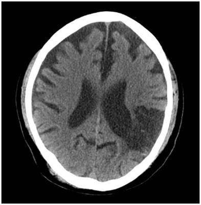 Case report: Diagnostic challenges in a patient with alcohol use disorder that developed following a stroke